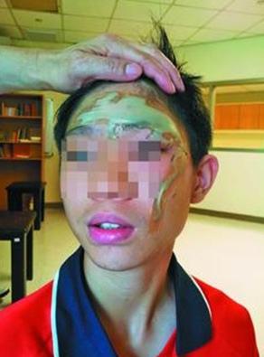 老師上課誤把濃硫酸當醋酸男生不慎被噴中毀容