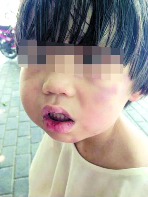 小涵臉頰、嘴唇上有瘀青和傷痕