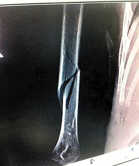 4歲男童幼兒園內(nèi)被老師拉到監(jiān)控死角扭斷手臂