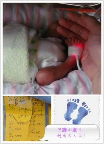 臺灣最輕早產(chǎn)兒僅395克 重量相當(dāng)于兩個蘋果