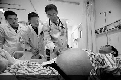 壯年男子因肝病出現(xiàn)肝腹水 肚子大如西瓜 