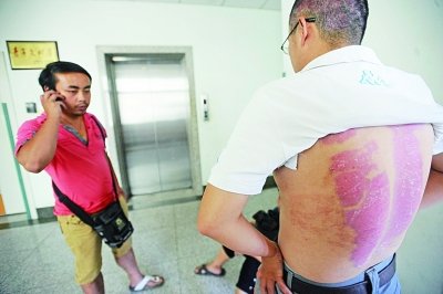 父親全身重度燒傷 長(zhǎng)子割皮次子賣房救父(圖)