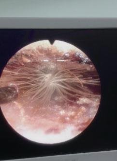 通過(guò)內(nèi)窺鏡屏幕可清晰看到耳道內(nèi)“長(zhǎng)”出的蒲公英 