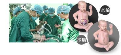 胎兒內(nèi)臟裸露體外 醫(yī)生產(chǎn)房?jī)?nèi)手術(shù)將其塞回(圖)