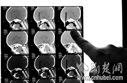 2歲男童吃面時(shí)摔倒 筷子插入顱內(nèi)8厘米